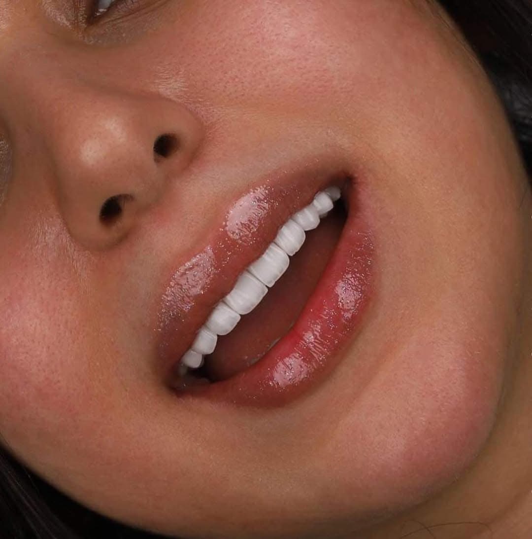 Why Choose Georgia for Dental Implants? | BuchoDenti Tbilisi