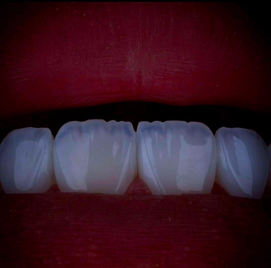 Why Choose BuchoDenti for Dental Implants in Georgia?