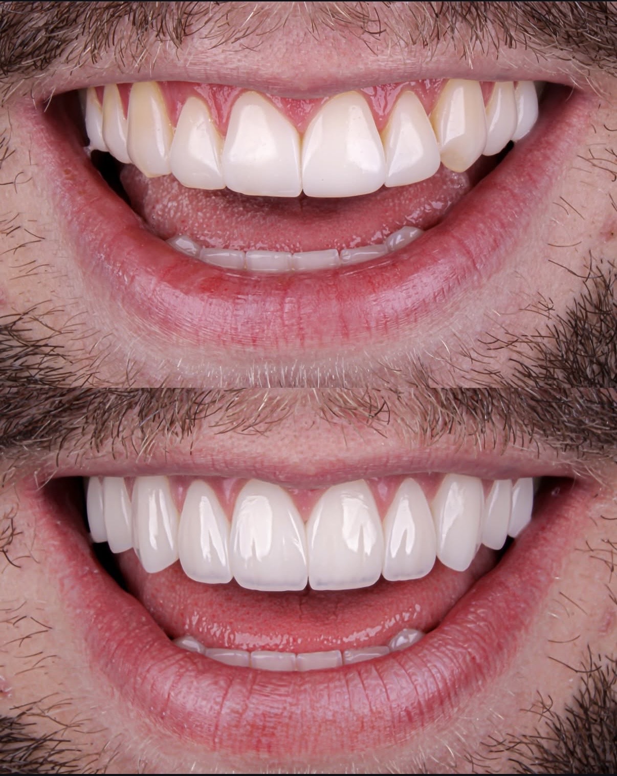 Personalized Dental Implant Treatment Planning in Georgia | BuchoDenti