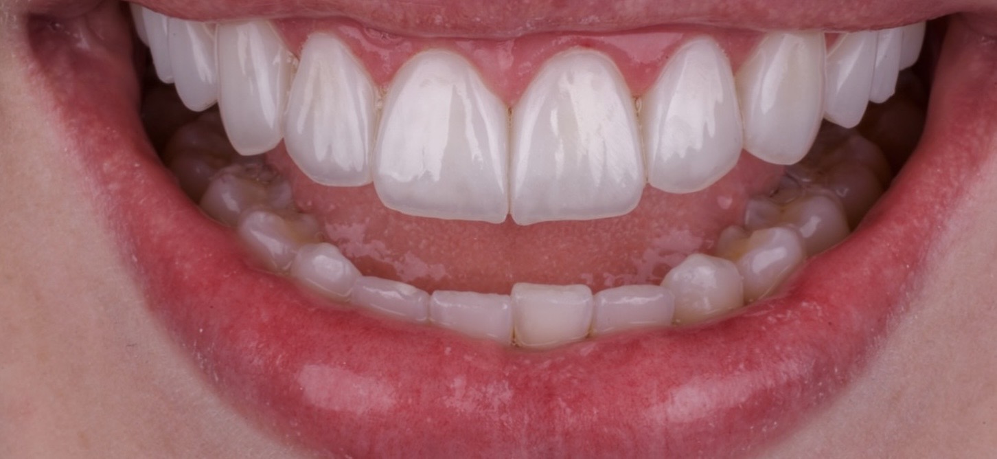 Dental Implants in Georgia for International Patients | BuchoDenti Tbilisi