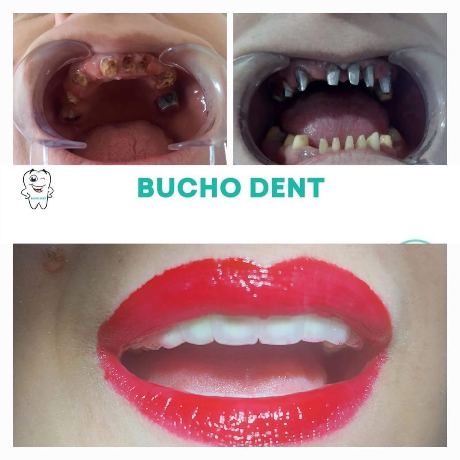 Dental Implants in Georgia: How BuchoDenti Builds a Personalized Treatment Plan for International Patients